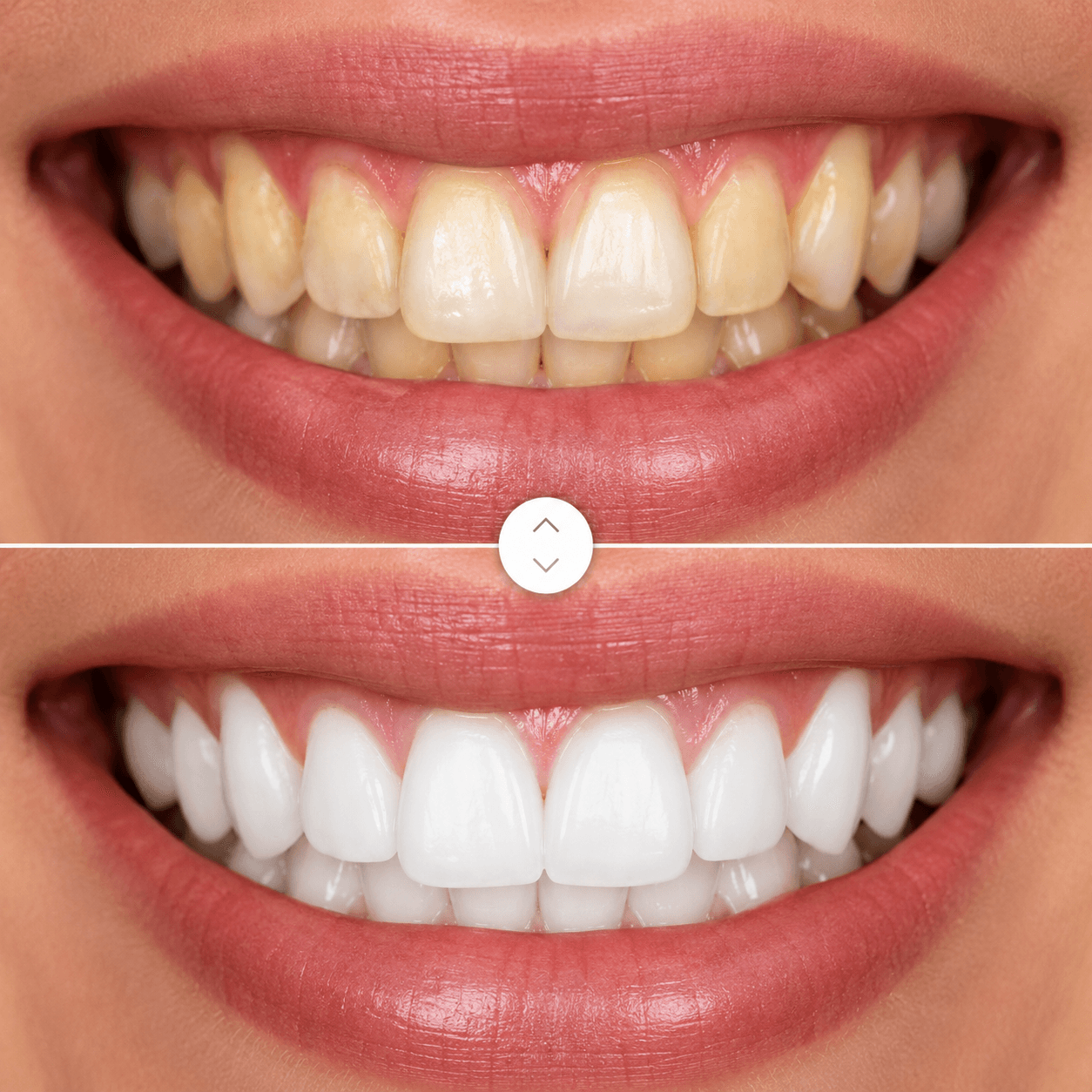 Clareamento Dental